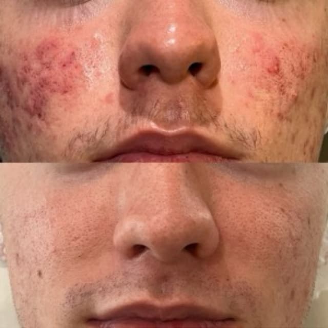 Treating Teenage Acne with Dr Platon Cold Plasma