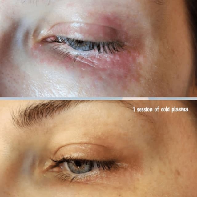 One treatment with Dr Platon Cold Plasma