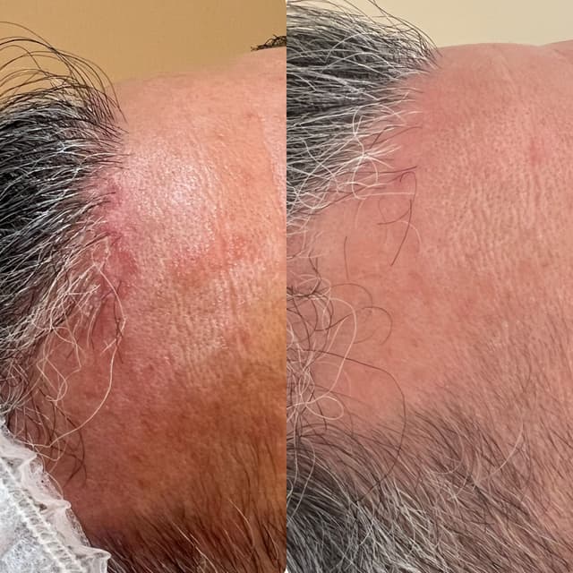 One week after first treatment with Dr Platon for psoriasis