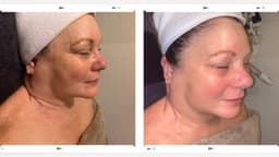 V-TOX lift Facial