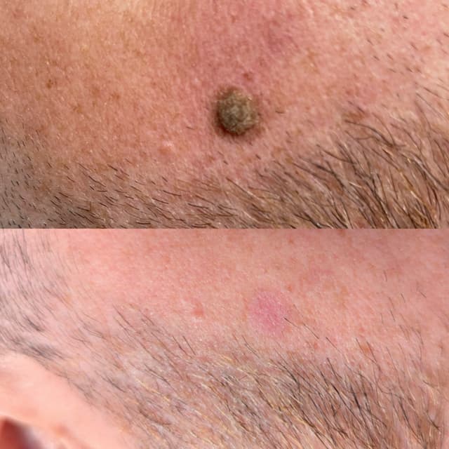Removing Seborrheic Keratosis with Cryotherapy